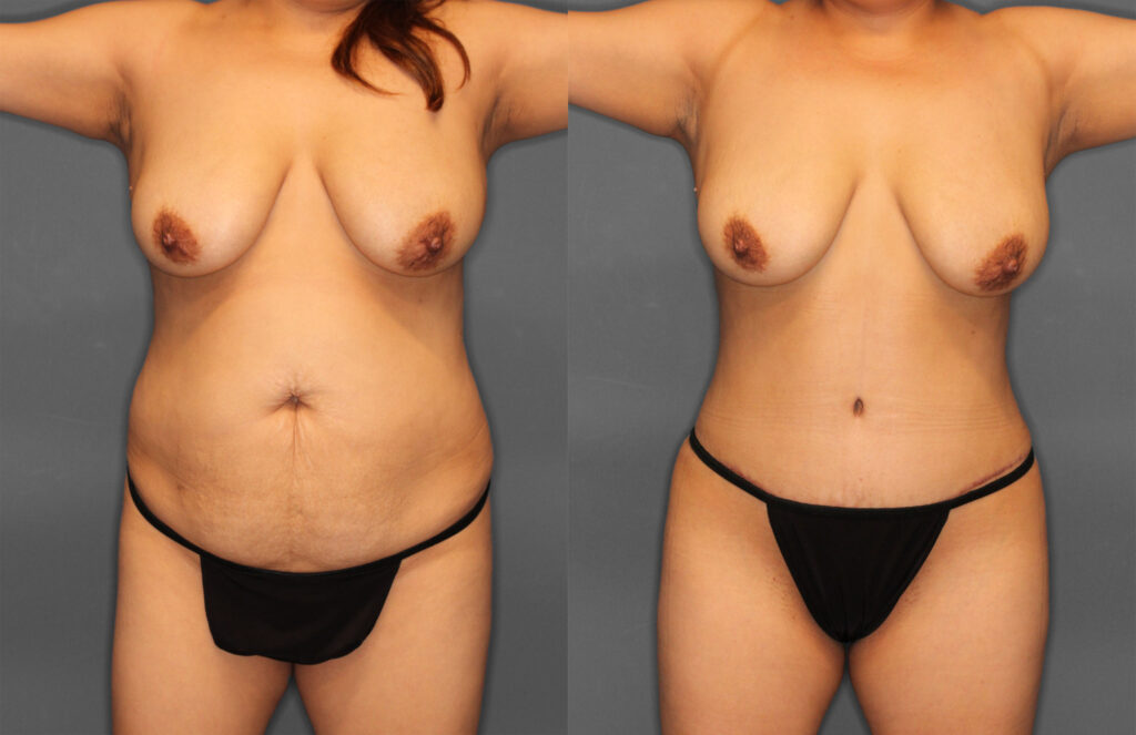Tummy Tuck Before and After photo by Dr. Abigail Rodriguez in Houston, TX