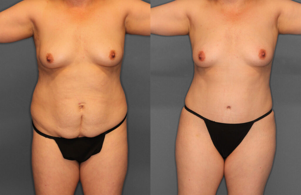 Tummy Tuck & Fat Grafting Before and After photo by Dr. Abigail Rodriguez in Houston, TX
