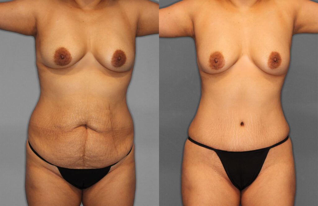 Tummy Tuck & Fat Grafting Before and After photo by Dr. Abigail Rodriguez in Houston, TX