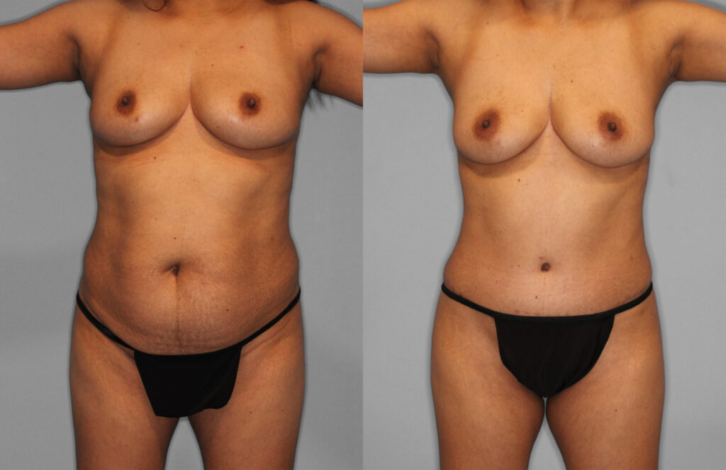 Tummy Tuck and Fat Grafting Before and After photo by Dr. Abigail Rodriguez in Houston, TX