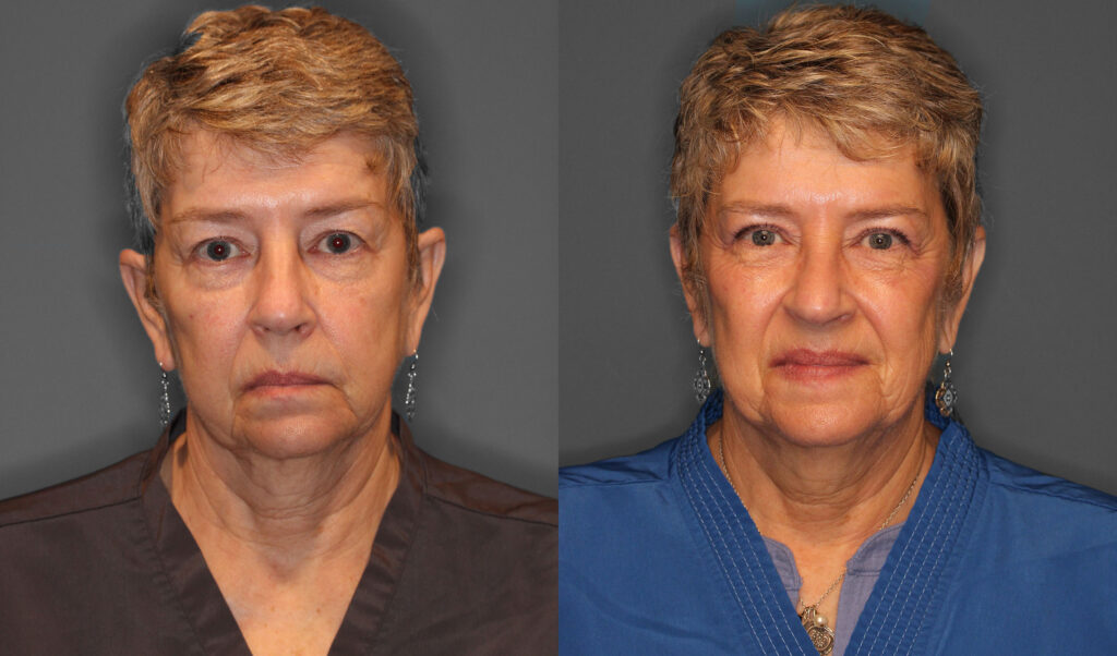 Upper Eyelid Lift Before and After photo by Dr. Abigail Rodriguez in Houston, TX
