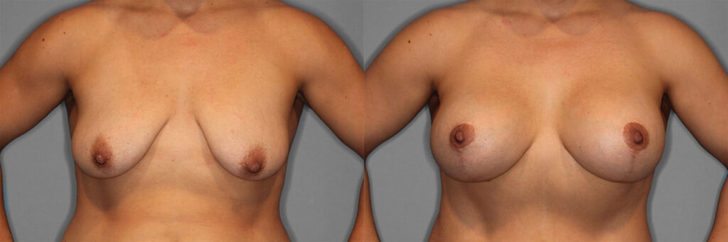 Breast Augmentation with Lift Before and After photo by Dr. Abigail Rodriguez in Houston, TX