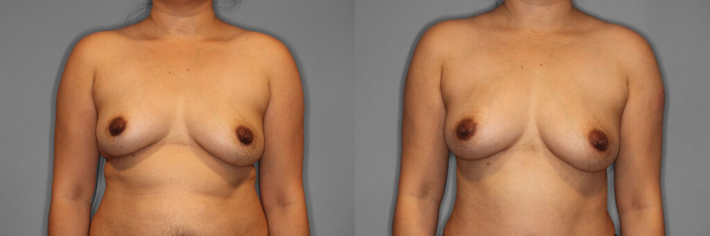 Breast Fat Grafting Before and After photo by Dr. Abigail Rodriguez in Houston, TX