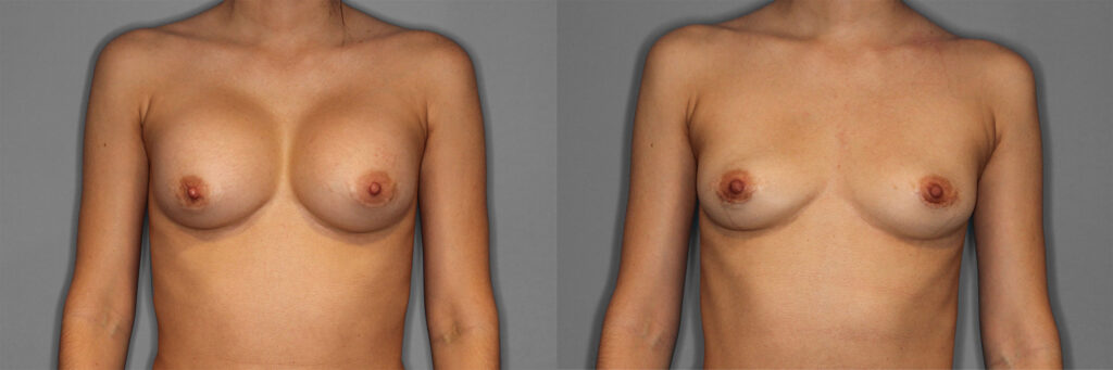Breast Implant Removal Before and After photo by Dr. Abigail Rodriguez in Houston, TX