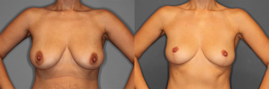 Breast Lift Before and After photo by Dr. Abigail Rodriguez in Houston, TX