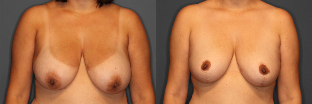 Breast Reduction Before and After photo by Dr. Abigail Rodriguez in Houston, TX