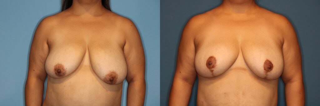 Breast Reduction Before and After photo by Dr. Abigail Rodriguez in Houston, TX