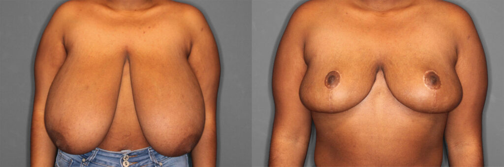 Breast Reduction Before and After photo by Dr. Abigail Rodriguez in Houston, TX
