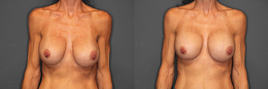 Breast Revision Before and After photo by Dr. Abigail Rodriguez in Houston, TX