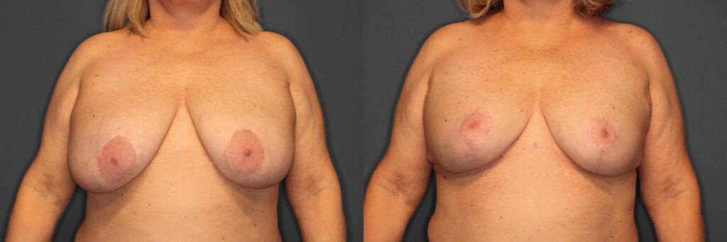 Breast Revision Before and After photo by Dr. Abigail Rodriguez in Houston, TX