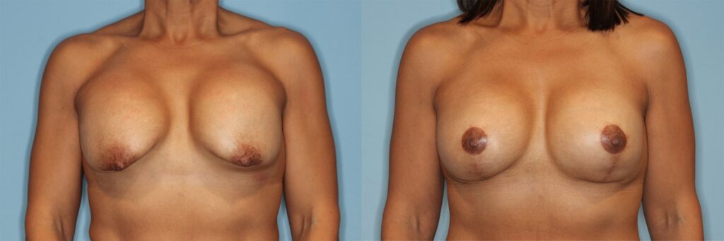 Breast Revision Before and After photo by Dr. Abigail Rodriguez in Houston, TX