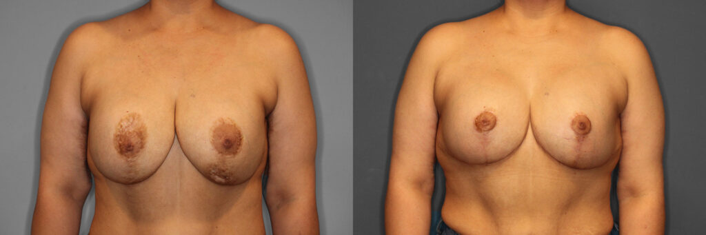 Breast Revision Before and After photo by Dr. Abigail Rodriguez in Houston, TX