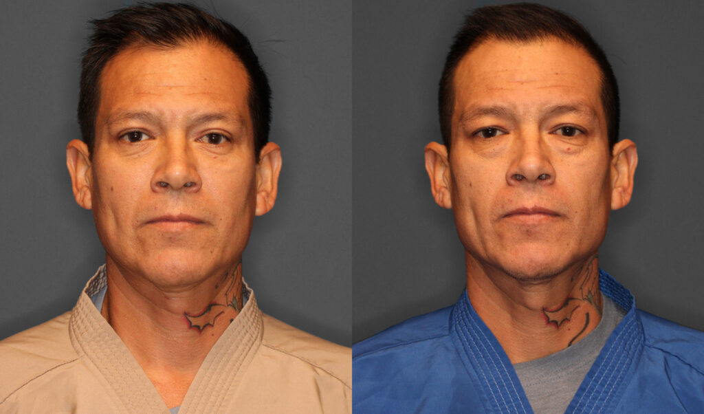 Eyelid Lift Before and After photo by Dr. Abigail Rodriguez in Houston, TX