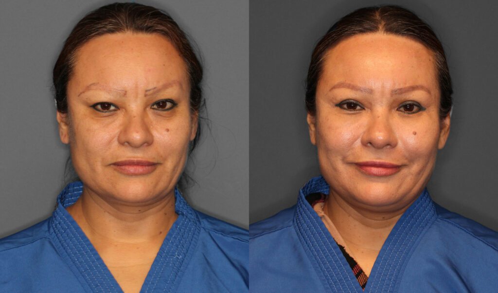 Eyelid Lift Before and After photo by Dr. Abigail Rodriguez in Houston, TX
