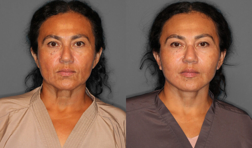 Face Neck Lift Before and After photo by Dr. Abigail Rodriguez in Houston, TX