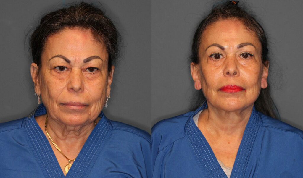 Face Neck Lift Eyelid Lift Fat Grafting Before and After photo by Dr. Abigail Rodriguez in Houston, TX