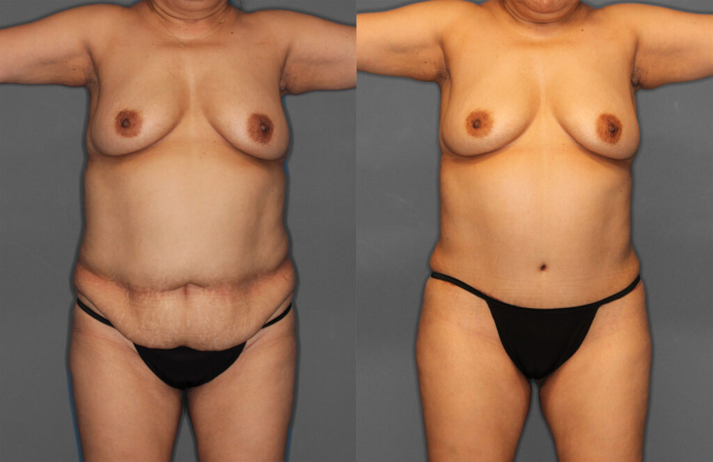 Tummy Tuck Before and After photo by Dr. Abigail Rodriguez in Houston, TX