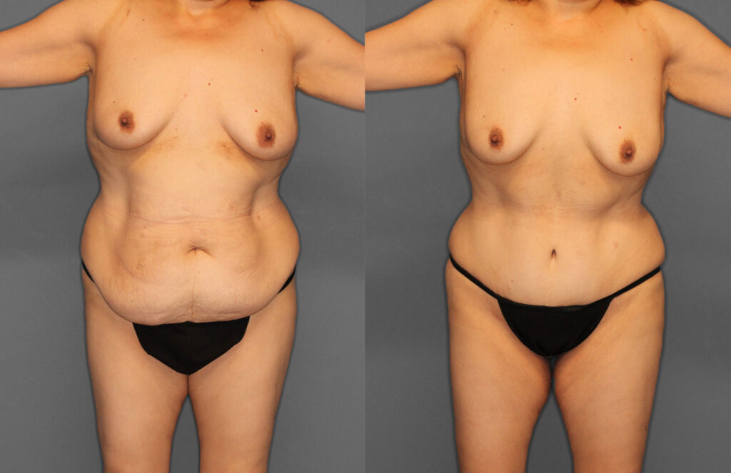 Tummy Tuck Before and After photo by Dr. Abigail Rodriguez in Houston, TX
