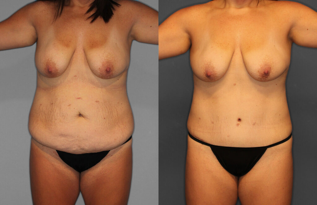 Tummy Tuck Before and After photo by Dr. Abigail Rodriguez in Houston, TX