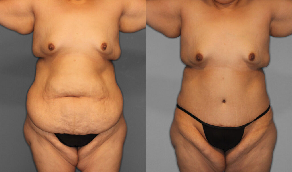Tummy Tuck Before and After photo by Dr. Abigail Rodriguez in Houston, TX