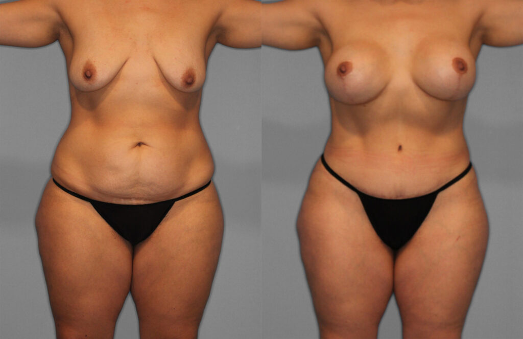 Tummy Tuck Before and After photo by Dr. Abigail Rodriguez in Houston, TX