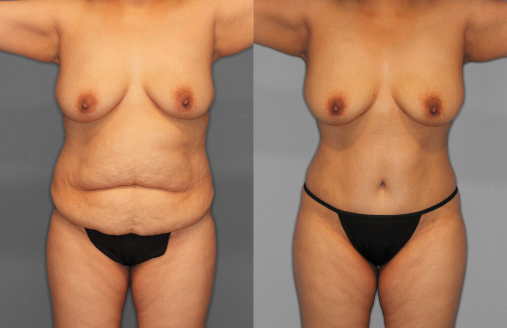 Tummy Tuck Before and After photo by Dr. Abigail Rodriguez in Houston, TX