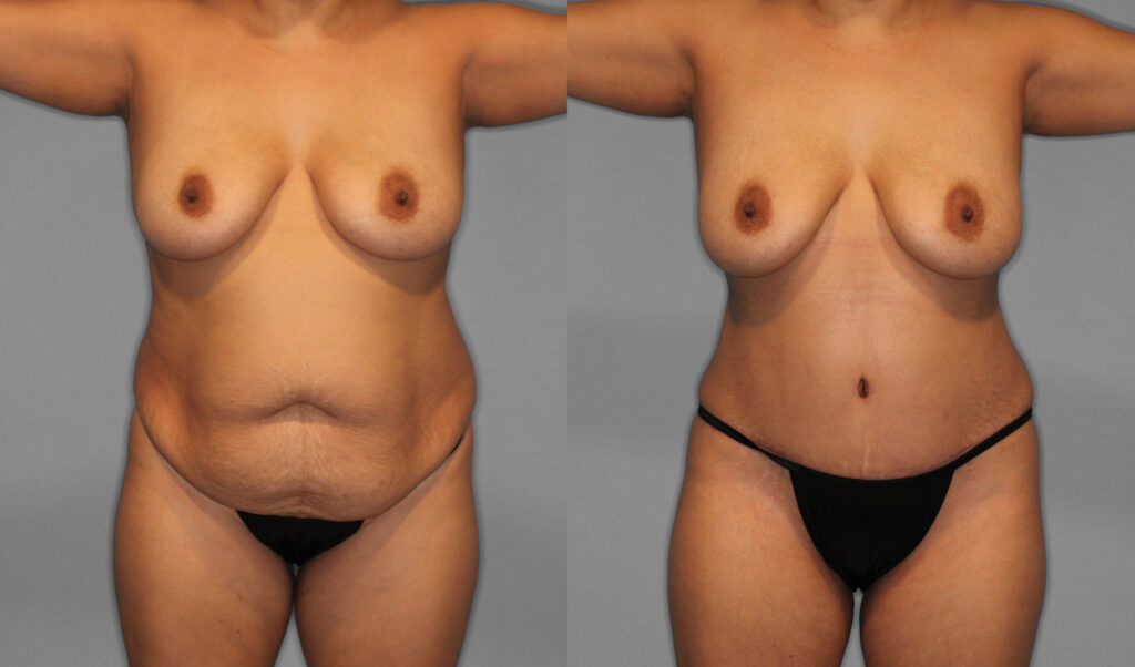 Tummy Tuck Before and After photo by Dr. Abigail Rodriguez in Houston, TX