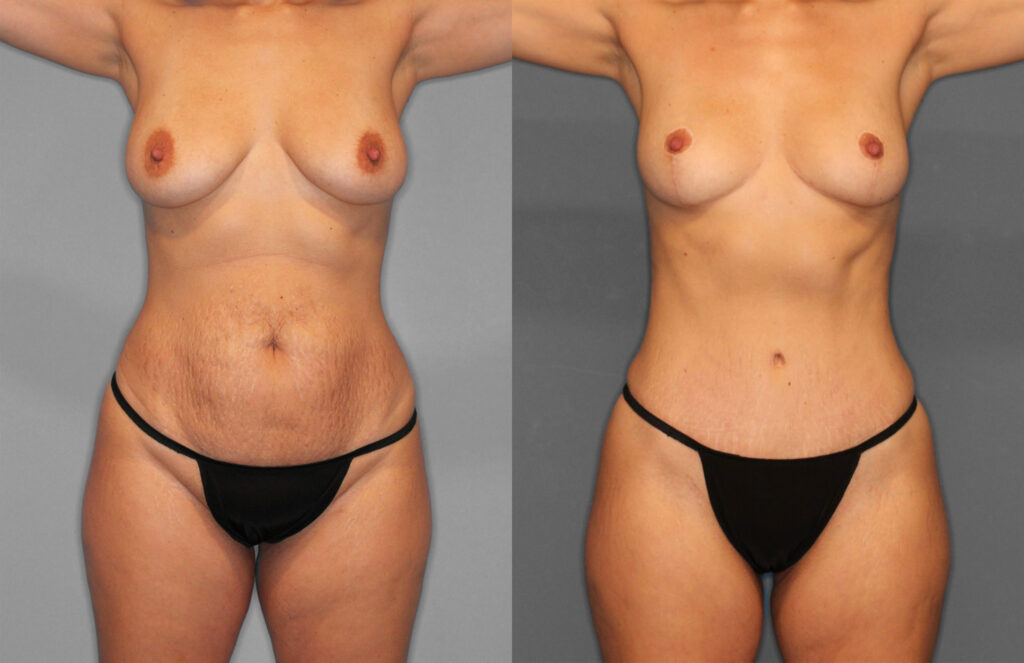 Tummy Tuck Before and After photo by Dr. Abigail Rodriguez in Houston, TX