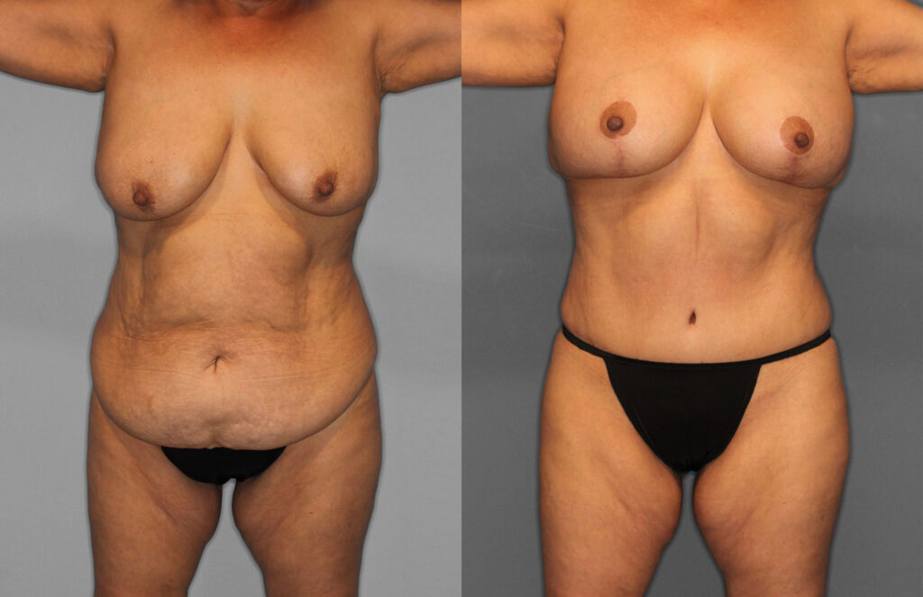 Tummy Tuck Before and After photo by Dr. Abigail Rodriguez in Houston, TX