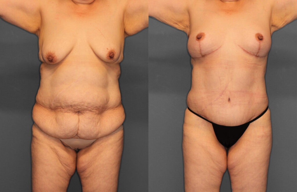 Tummy Tuck Before and After photo by Dr. Abigail Rodriguez in Houston, TX