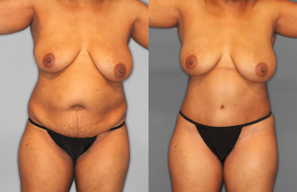 Tummy Tuck Before and After photo by Dr. Abigail Rodriguez in Houston, TX