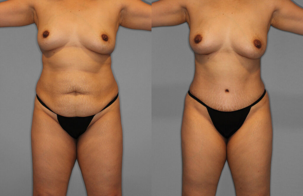 Tummy Tuck Before and After photo by Dr. Abigail Rodriguez in Houston, TX