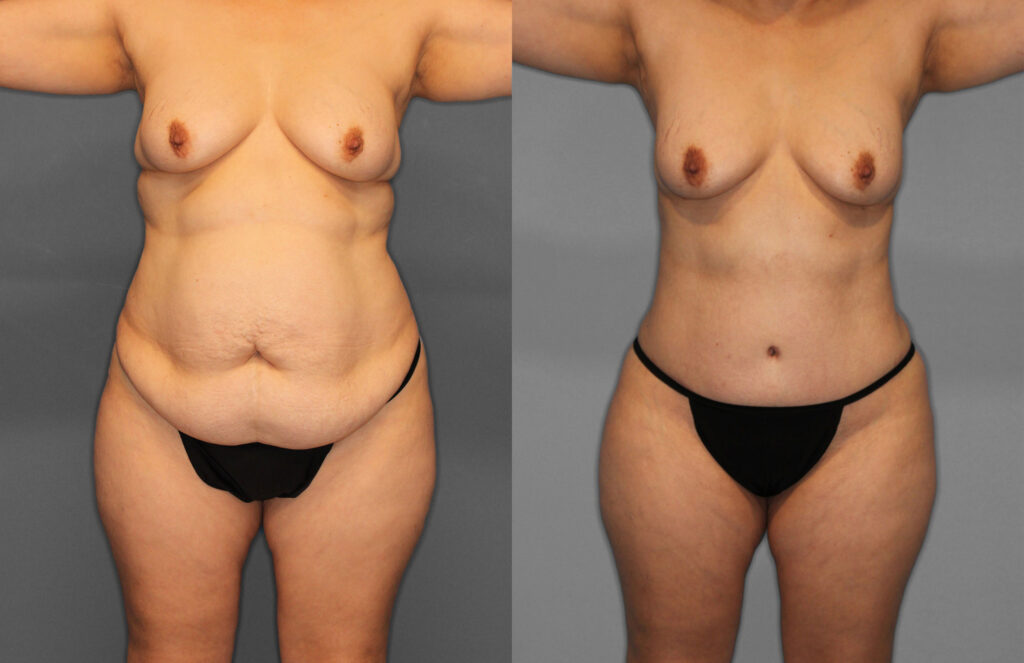 Tummy Tuck Before and After photo by Dr. Abigail Rodriguez in Houston, TX