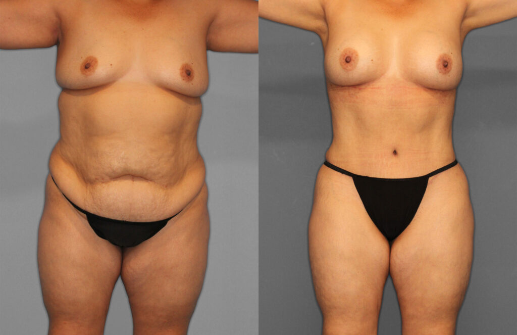 Tummy Tuck Before and After photo by Dr. Abigail Rodriguez in Houston, TX