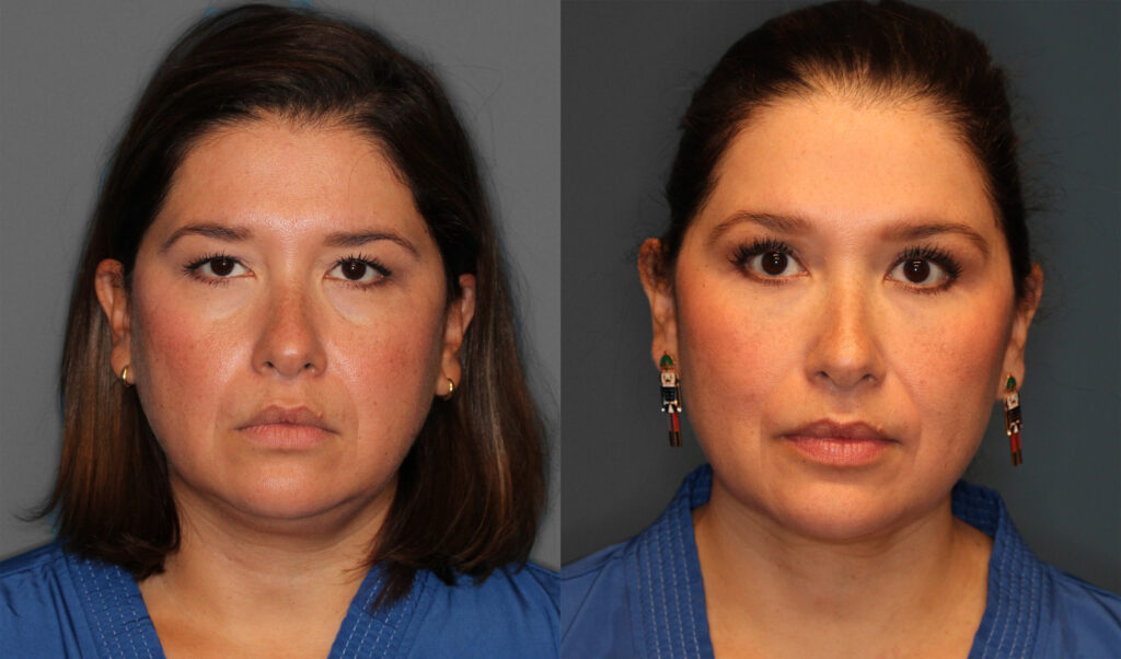 Upper Eyelid Before and After photo by Dr. Abigail Rodriguez in Houston, TX