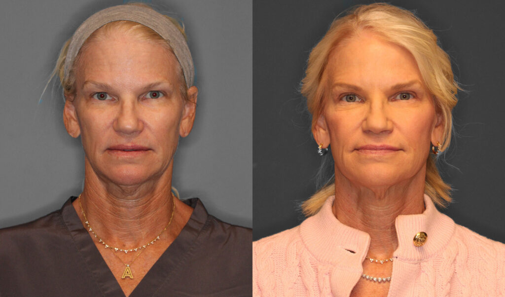 Upper Eyelid Before and After photo by Dr. Abigail Rodriguez in Houston, TX