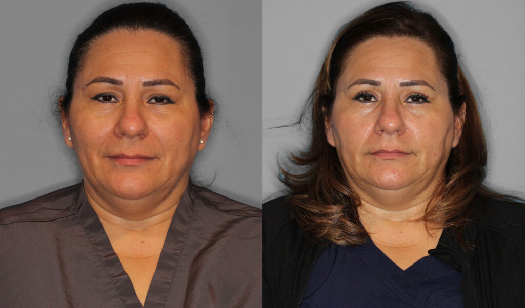 Upper Eyelid Before and After photo by Dr. Abigail Rodriguez in Houston, TX