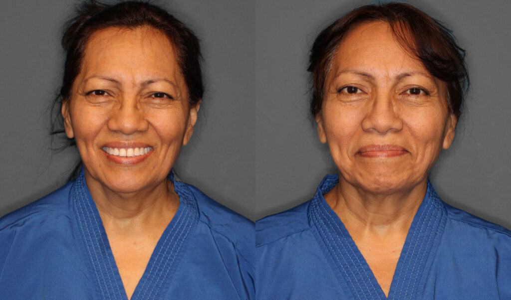 Upper Eyelid Brow Lift Before and After photo by Dr. Abigail Rodriguez in Houston, TX
