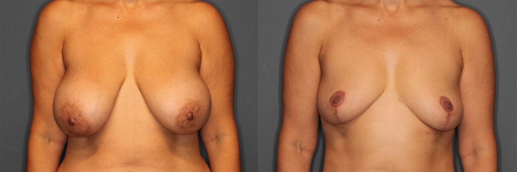 Implant Removal + Lift Before and After photo by Dr. Abigail Rodriguez in Houston, TX