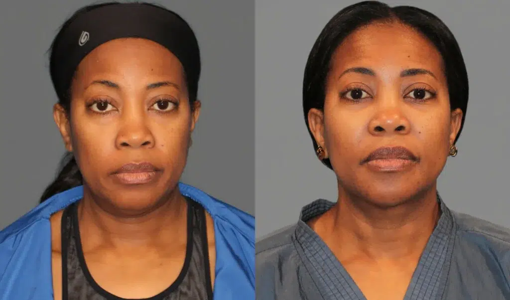 Lower Eyelid Lift + Neck Lipo with Renuvion Before and After photo by Dr. Rodriguez