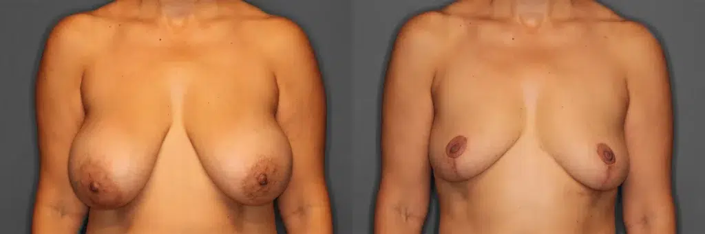 Mastopexy & Implant Removal Before and After photo by Dr. Rodriguez